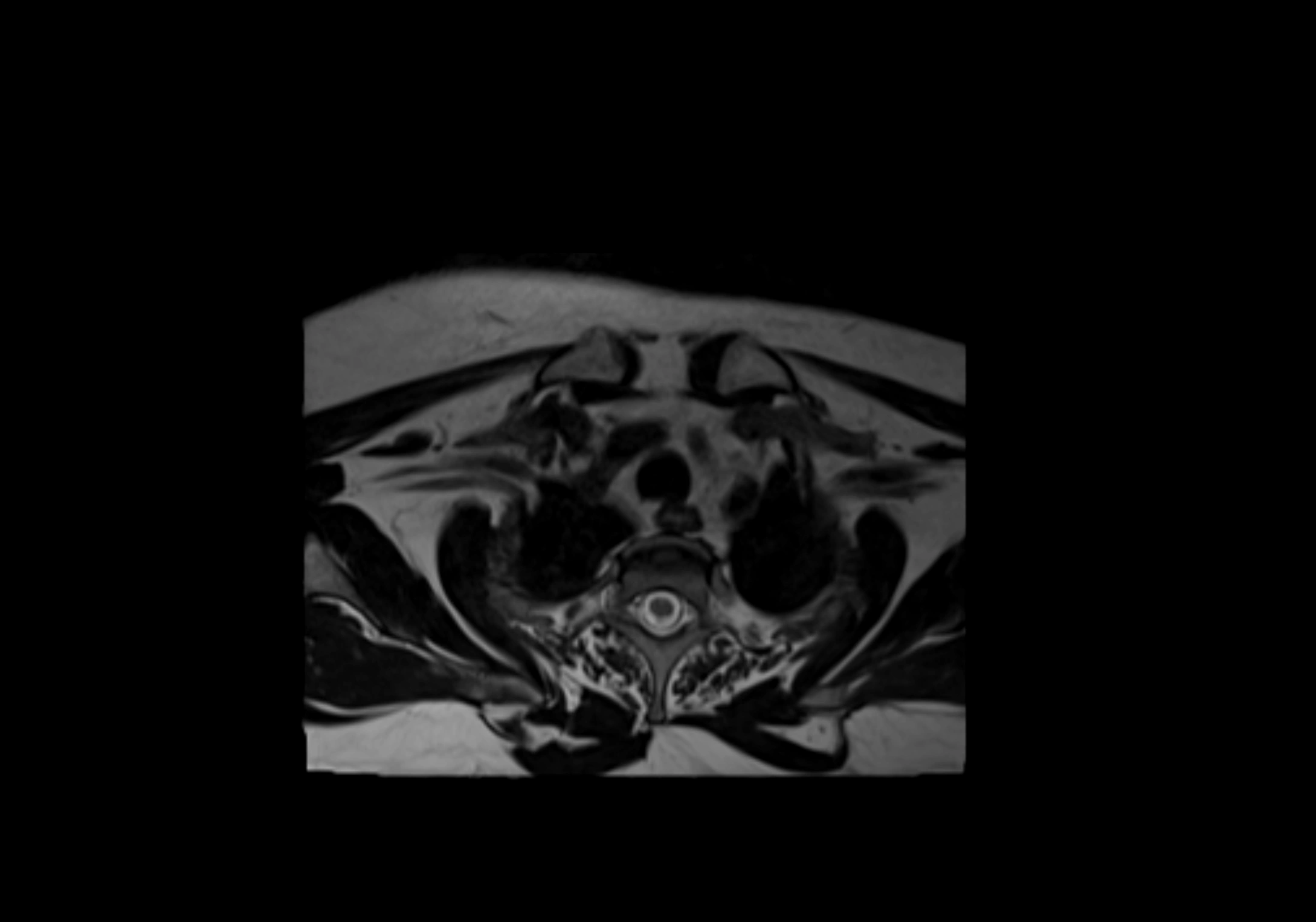 Neck axial  lymph node cross sectional MRI anatomy 3T MRI  image-img-00001-00096.webp
